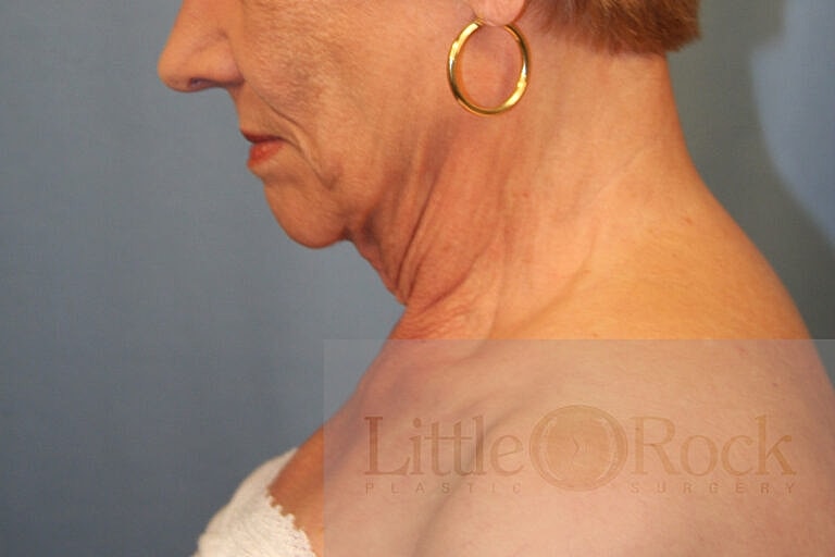 Neck Lift Before & After
