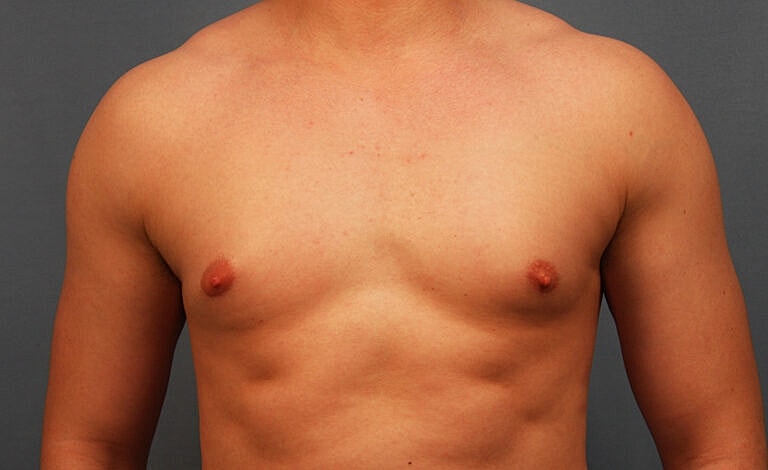 Gynecomastia Before & After