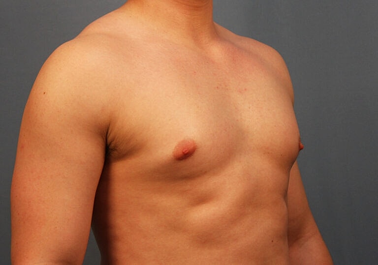 Gynecomastia Before & After