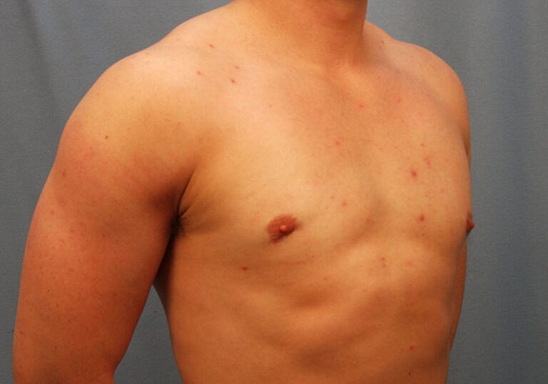 Gynecomastia Before & After