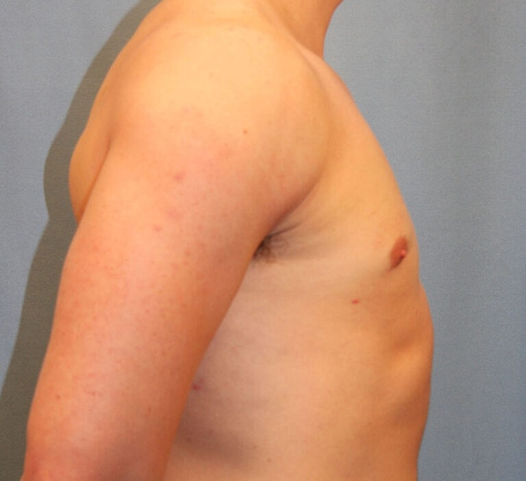 Gynecomastia Before & After