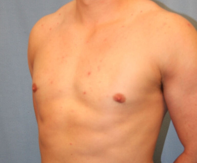 Gynecomastia Before & After
