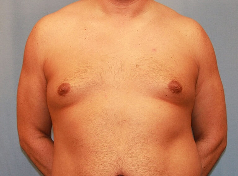 Gynecomastia Before & After