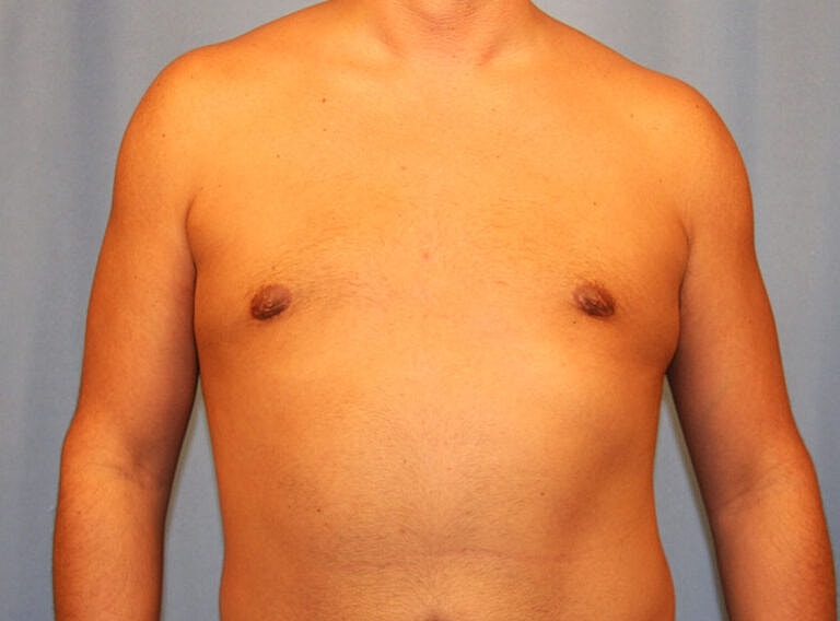 Gynecomastia Before & After