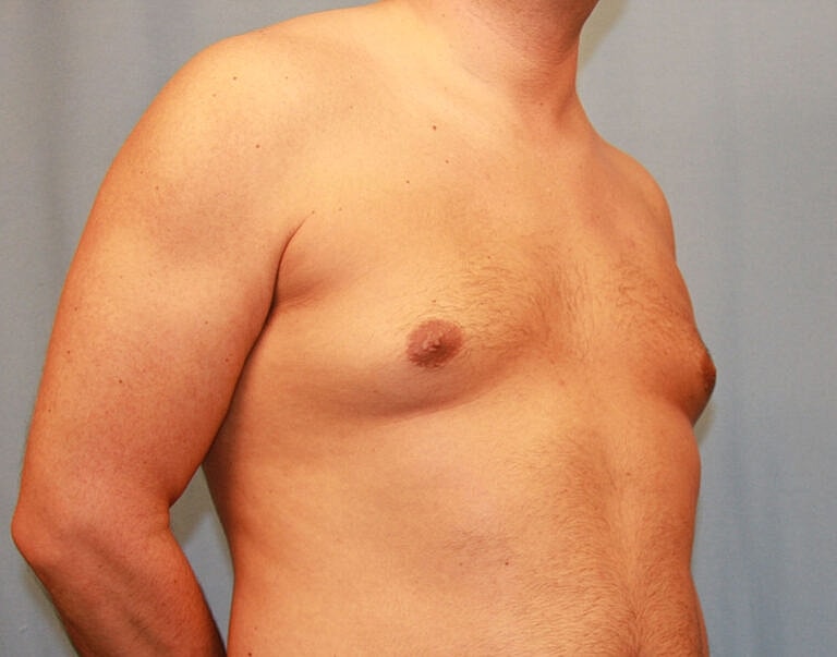 Gynecomastia Before & After