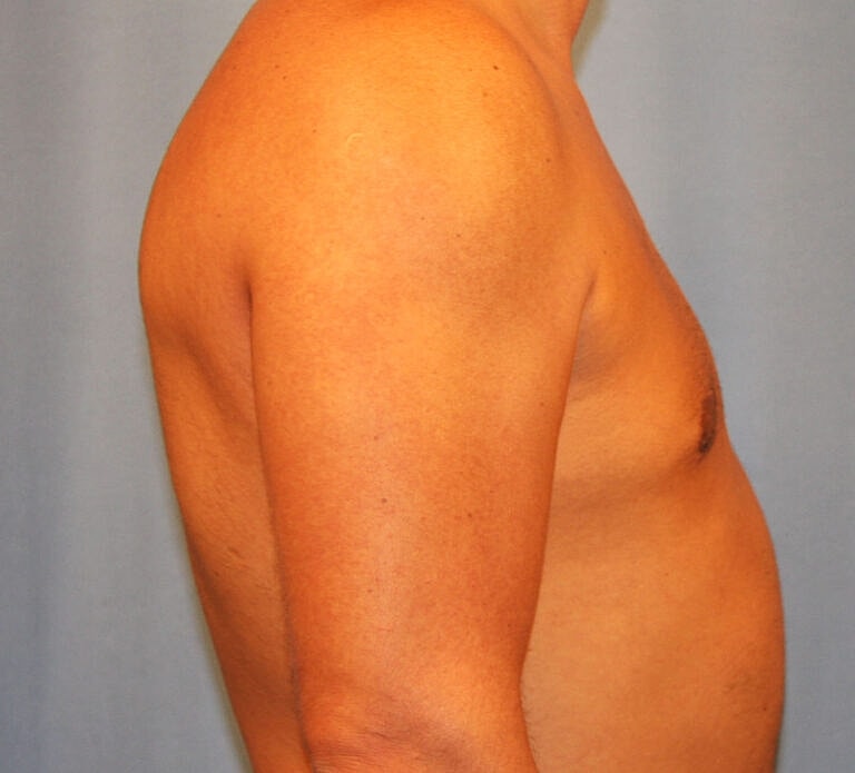 Gynecomastia Before & After