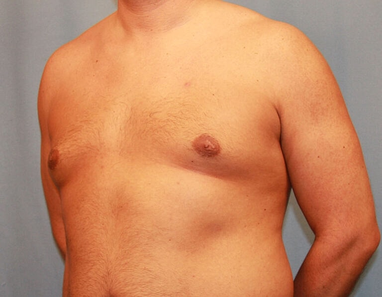 Gynecomastia Before & After