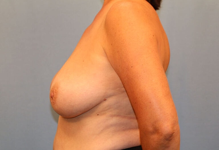 Breast Lift Before & After
