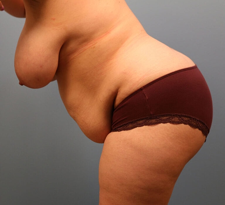 Breast Lift Before & After