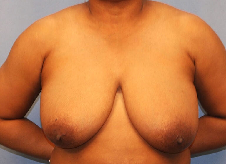 Breast Reduction Before & After