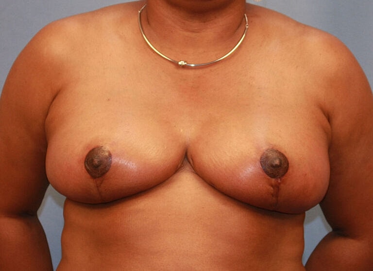 Breast Reduction Before & After