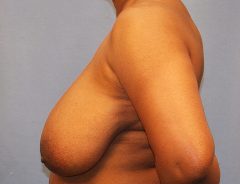 Breast Reduction Before & After