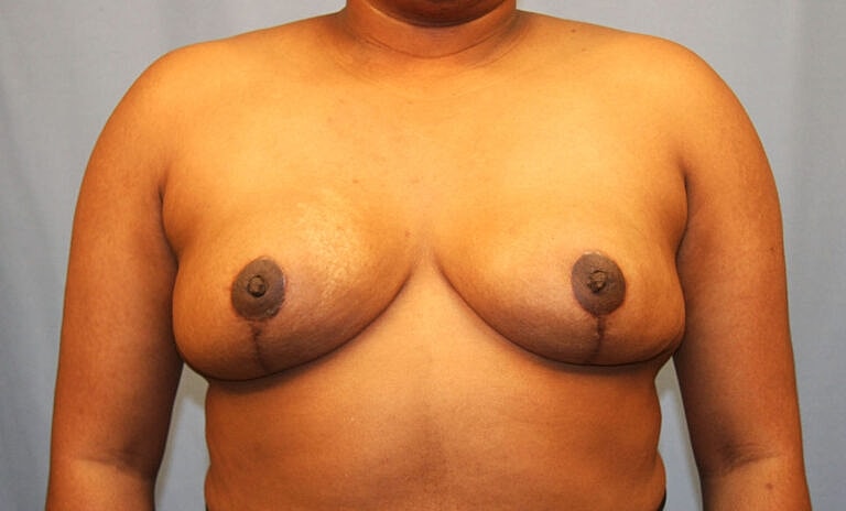 Breast Reduction Before & After
