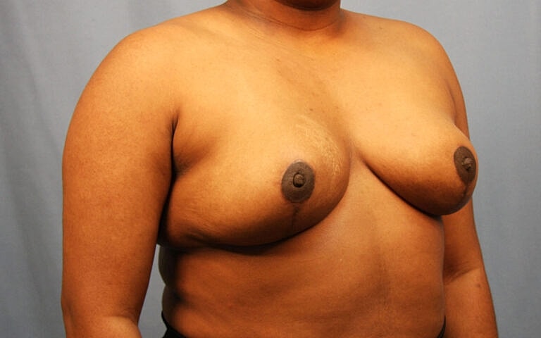 Breast Reduction Before & After