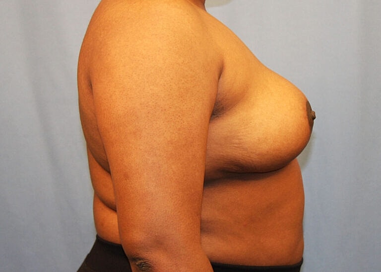 Breast Reduction Before & After