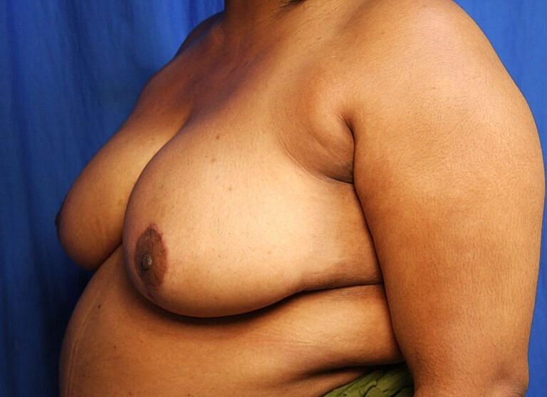 Breast Reduction Before & After