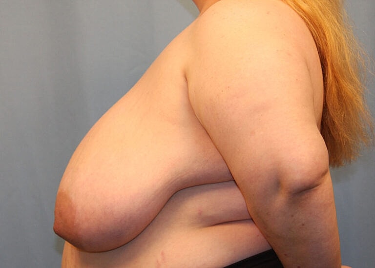 Breast Reduction Before & After