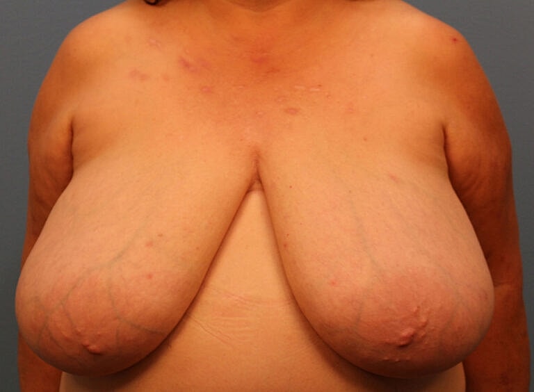 Breast Reduction Before & After