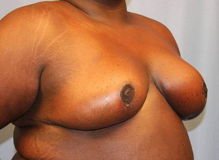 Breast Reduction Before & After
