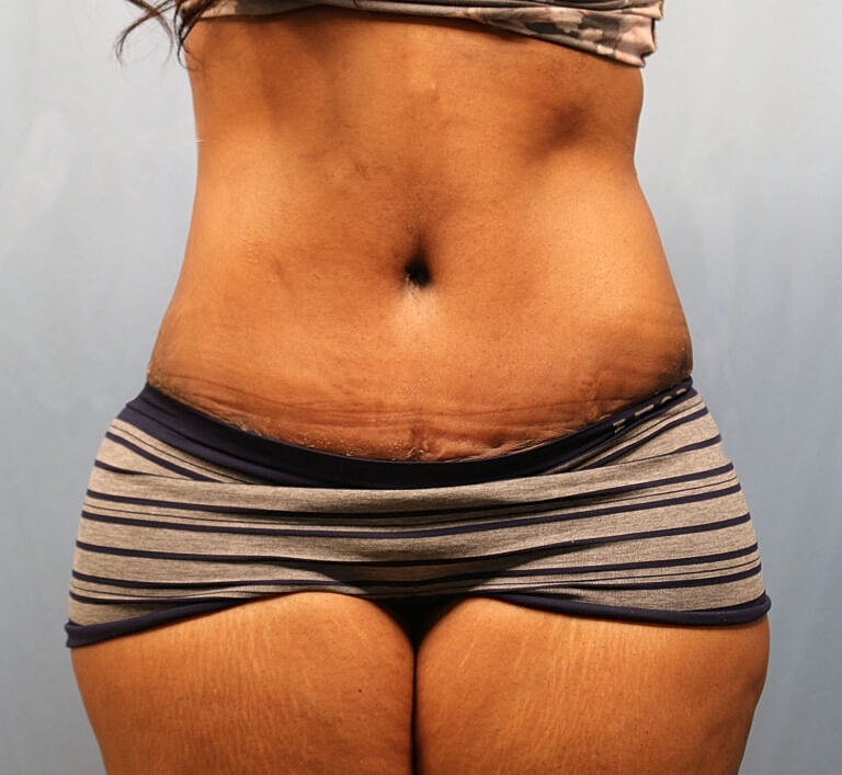Abdominoplasty Tummy Tuck Before & After