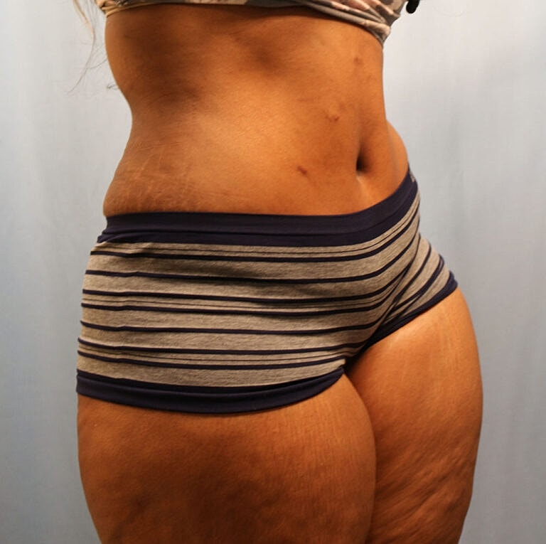 Abdominoplasty Tummy Tuck Before & After