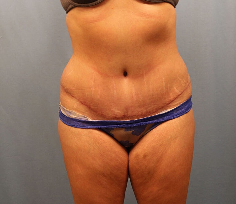 Abdominoplasty Tummy Tuck Before & After