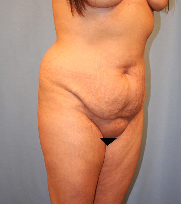 Abdominoplasty Tummy Tuck Before & After