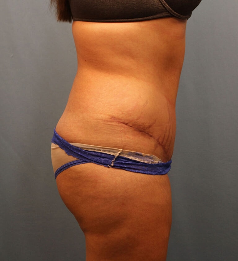 Abdominoplasty Tummy Tuck Before & After