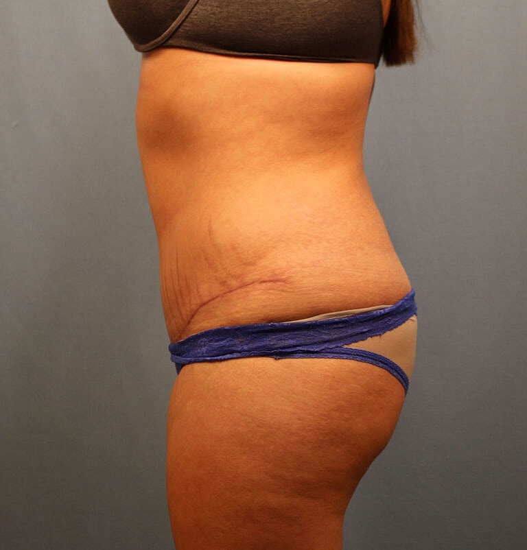 Abdominoplasty Tummy Tuck Before & After