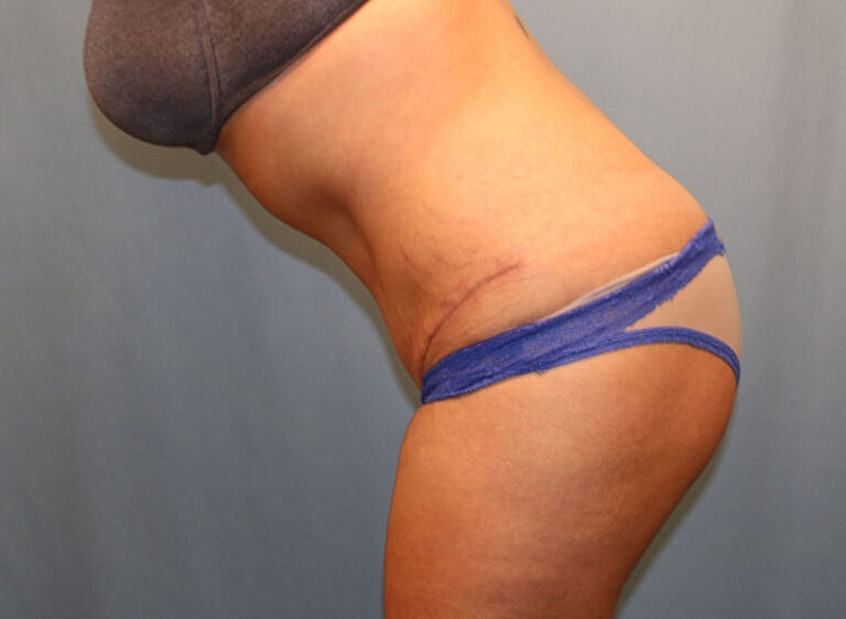 Abdominoplasty Tummy Tuck Before & After