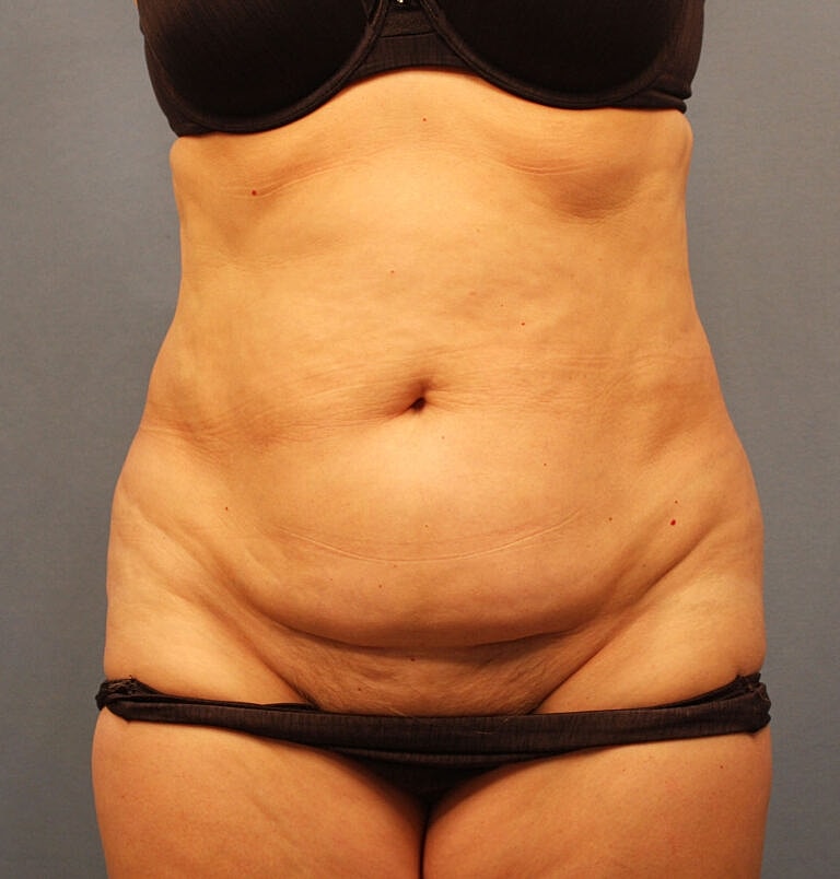 Abdominoplasty Tummy Tuck Before & After
