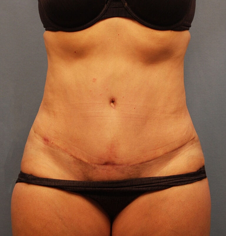 Abdominoplasty Tummy Tuck Before & After