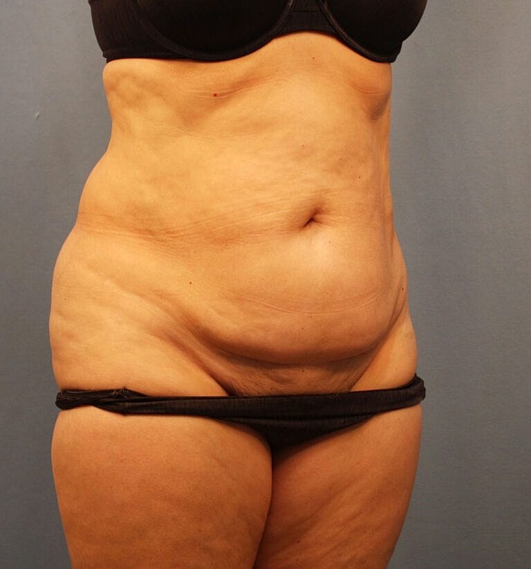 Abdominoplasty Tummy Tuck Before & After