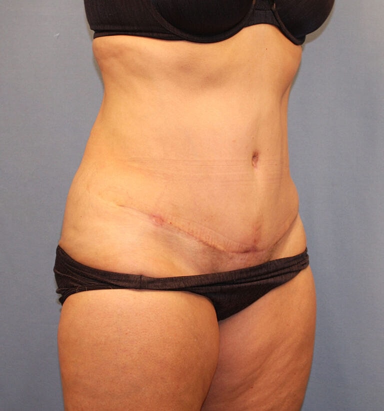 Abdominoplasty Tummy Tuck Before & After