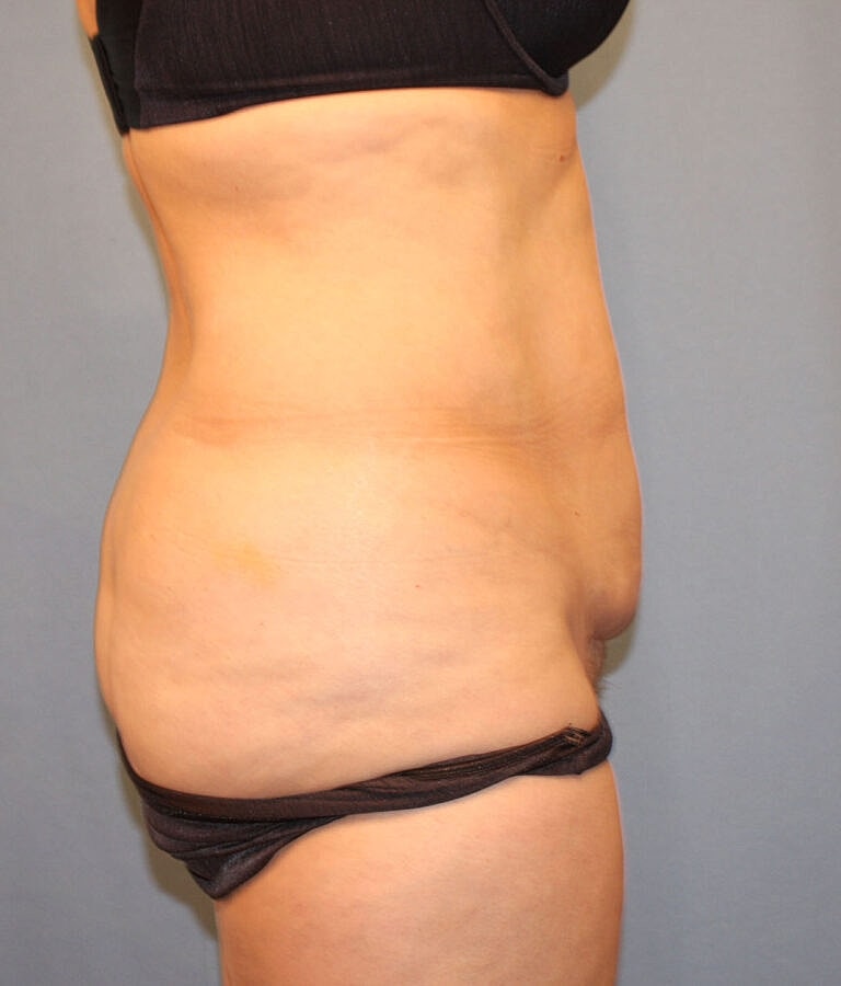 Abdominoplasty Tummy Tuck Before & After