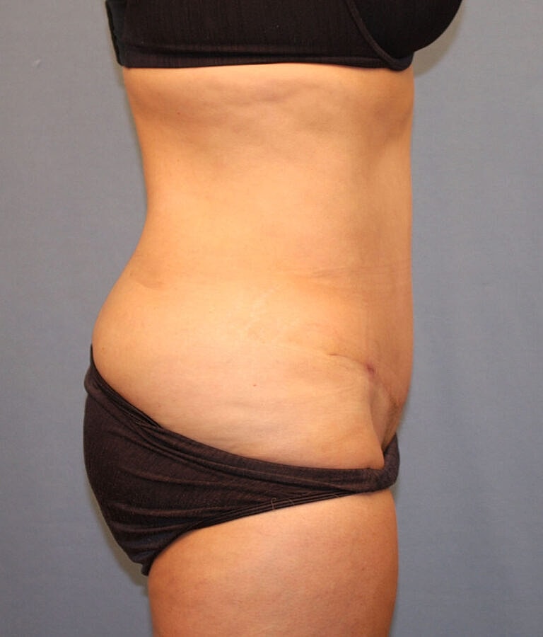 Abdominoplasty Tummy Tuck Before & After