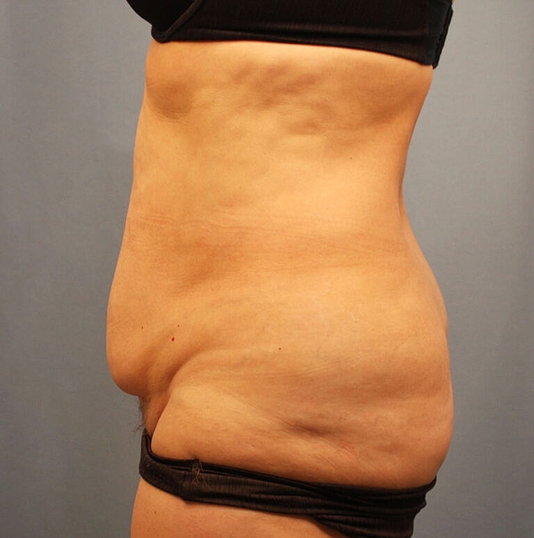Abdominoplasty Tummy Tuck Before & After