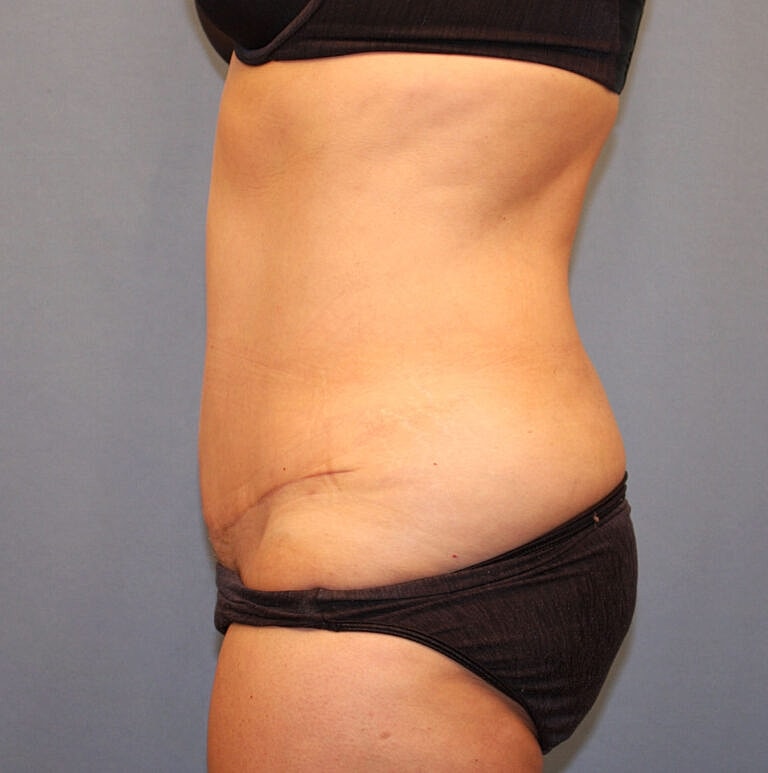 Abdominoplasty Tummy Tuck Before & After
