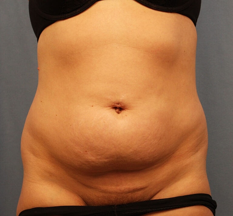 Abdominoplasty Tummy Tuck Before & After