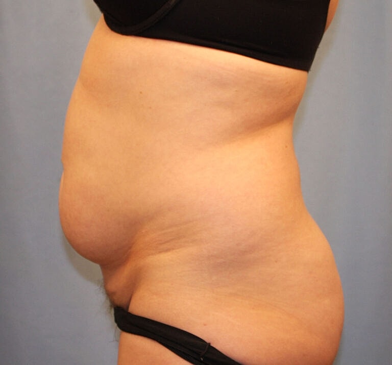 Abdominoplasty Tummy Tuck Before & After