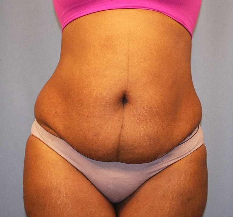 Abdominoplasty Tummy Tuck Before & After
