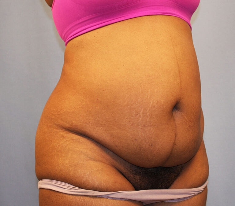 Abdominoplasty Tummy Tuck Before & After