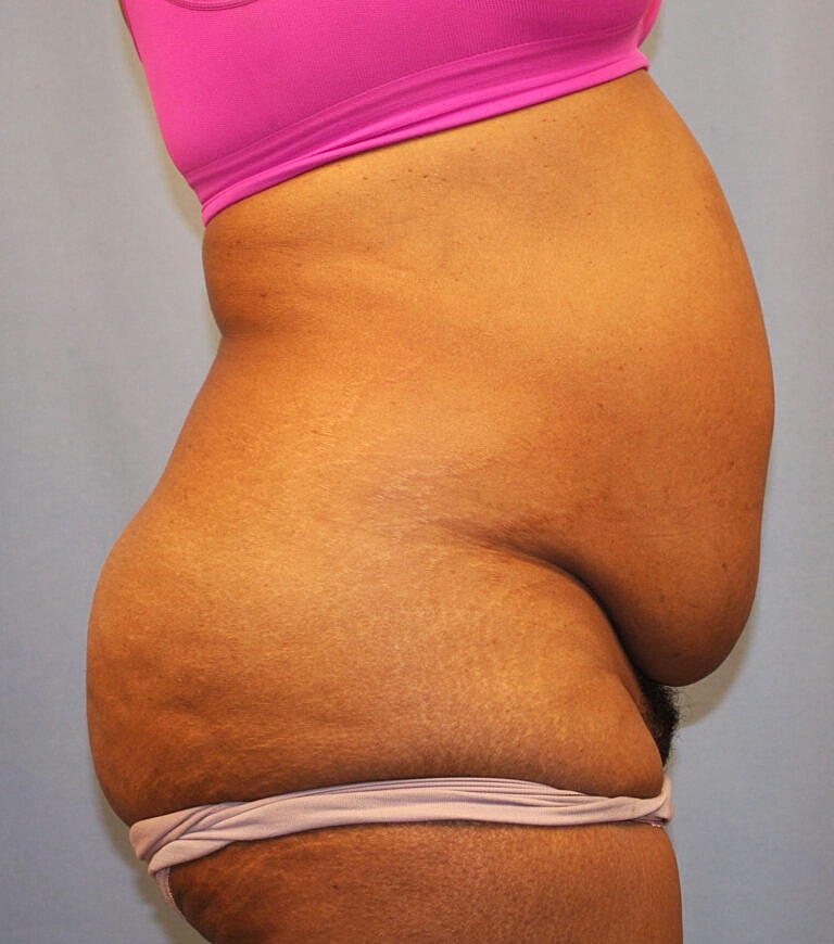 Abdominoplasty Tummy Tuck Before & After