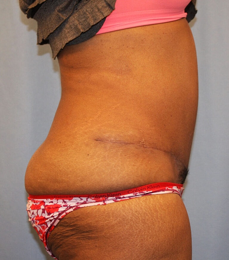 Abdominoplasty Tummy Tuck Before & After