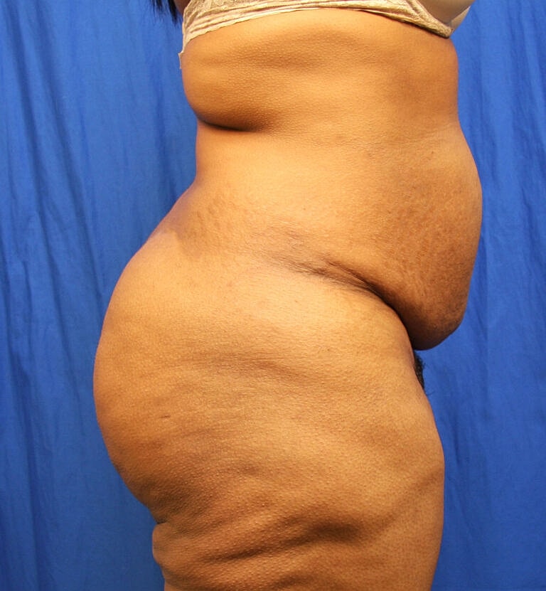 Abdominoplasty Tummy Tuck Before & After