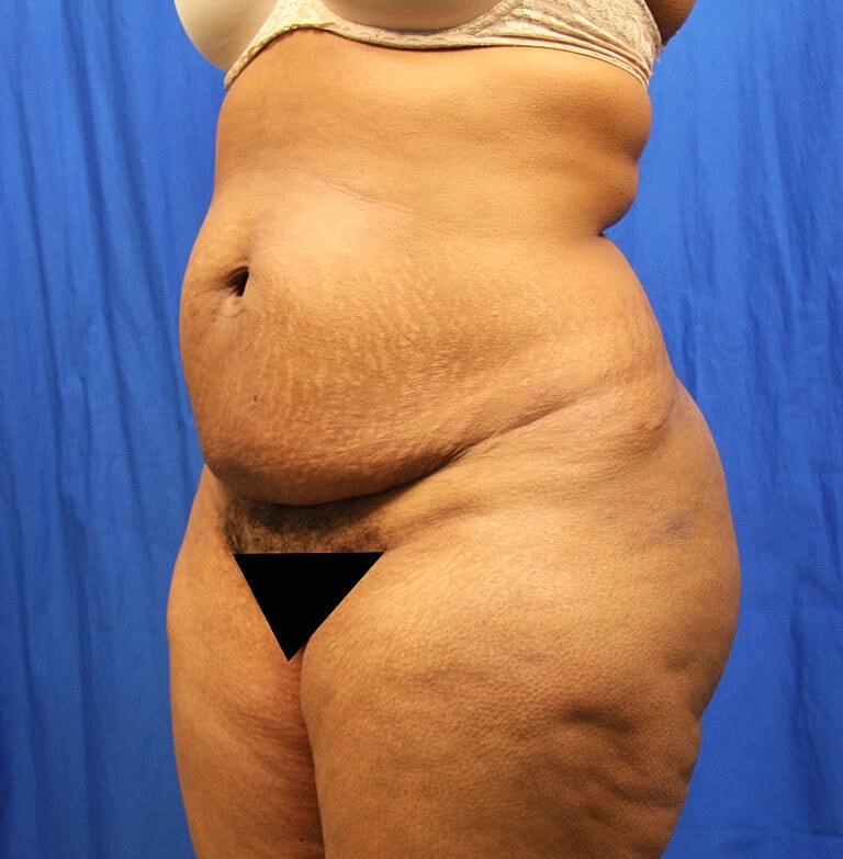 Abdominoplasty Tummy Tuck Before & After