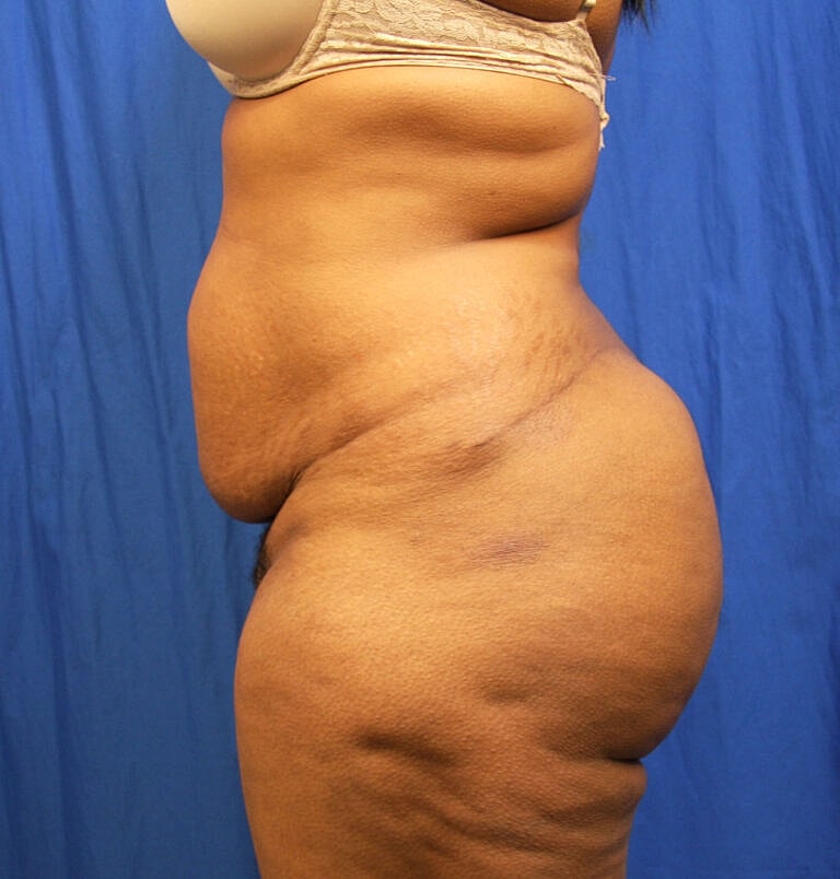 Abdominoplasty Tummy Tuck Before & After