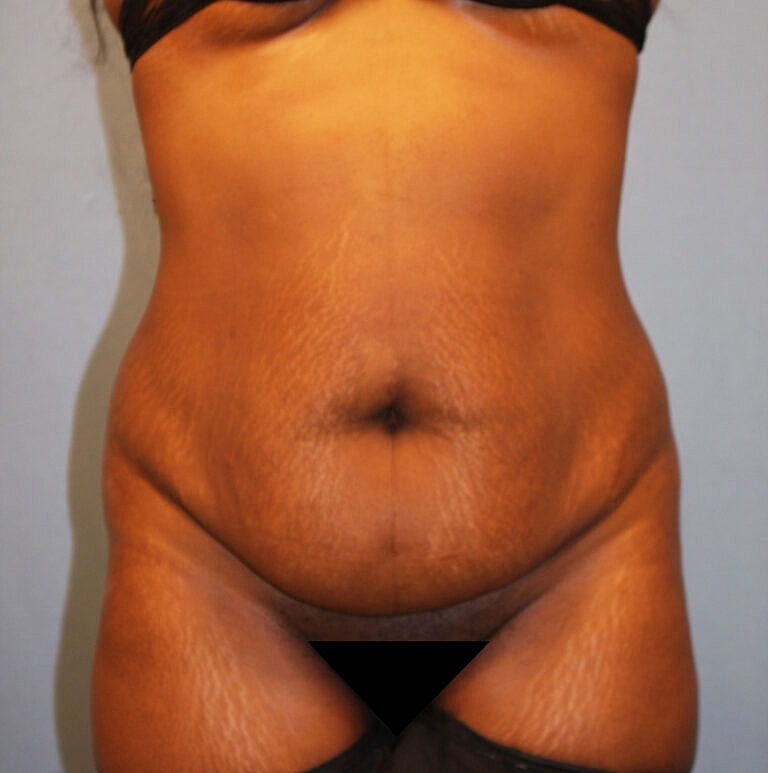 Abdominoplasty Tummy Tuck Before & After