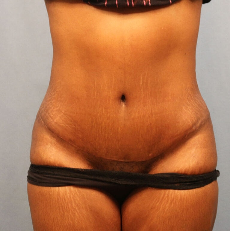 Abdominoplasty Tummy Tuck Before & After