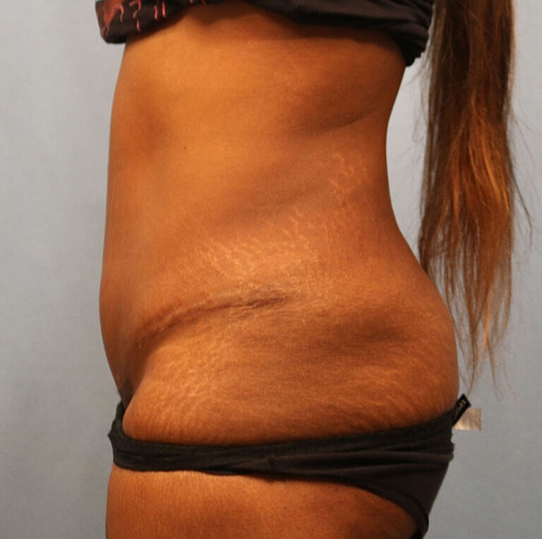 Abdominoplasty Tummy Tuck Before & After